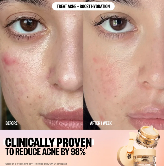 PEACE OUT ACNE GEL MOISTURIZER