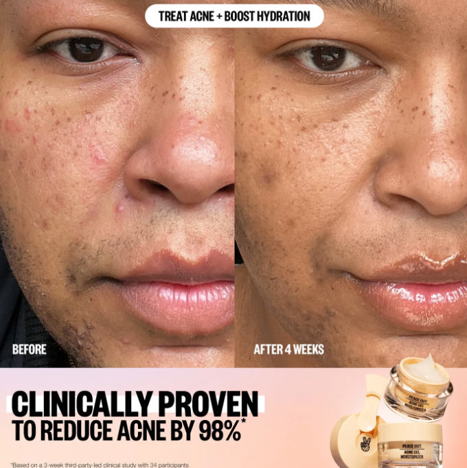 PEACE OUT ACNE GEL MOISTURIZER