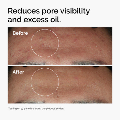 The Ordinary Niacinamide 10% + Zinc 1% – Sérum Facial para Poros y Exceso de Grasa 30 ml